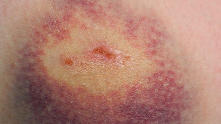 سرطان الدم النقوي الحاد (AML) يسبب طفح جلدي