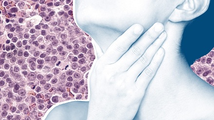 أعراض سرطان الدم الليمفاوي عدوى متكررة
