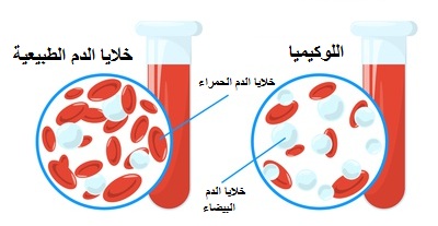 اللوكيميا مرض يصيب خلايا الدم