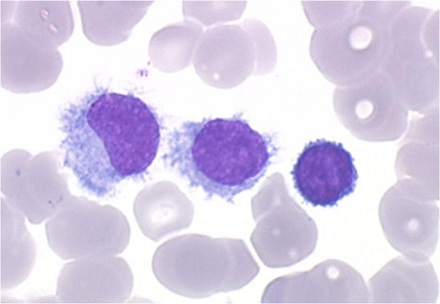 سرطان الدم مشعر الخلايا (HCL)